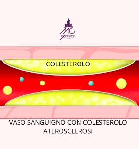 Com'è un vaso sanguigno con colesterolo (aterosclerosi)